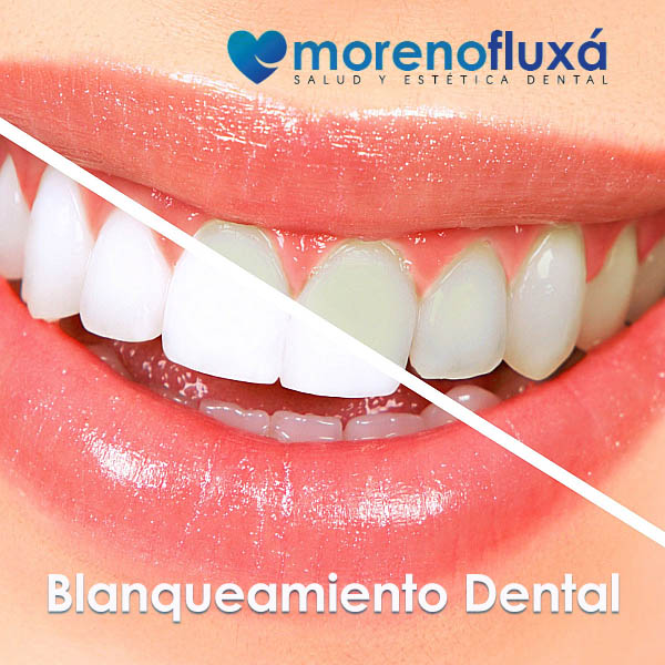El blanqueamiento dental en Moncloa / Arguelles